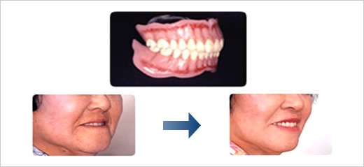 アンチエイジング入れ歯システム