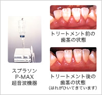 スプラソンP-MAX超音波機器 トリートメント前の歯茎の状態 トリートメント後の歯茎の状態（はれがひいてきています）