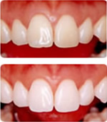 アンチエイジングと審美のための歯のホワイトニングのイメージ