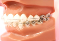 アンチエイジングと審美のための歯列矯正治療のイメージ